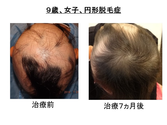 円形脱毛症　病院